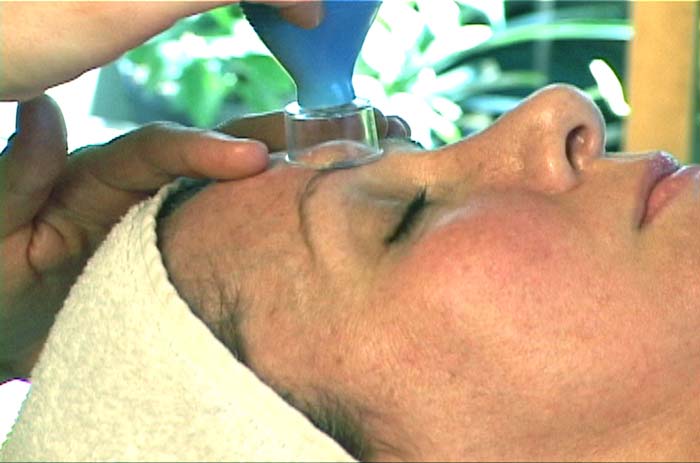Cupping Therapy: Relief for the Face, Head and Neck